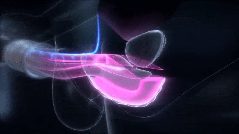 Xtensity Giph 2 stärkere Stimulation